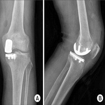 xray ostheoarthritis bicos